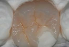 mini_pdt
